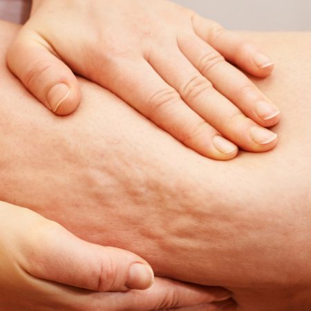 Cellulite