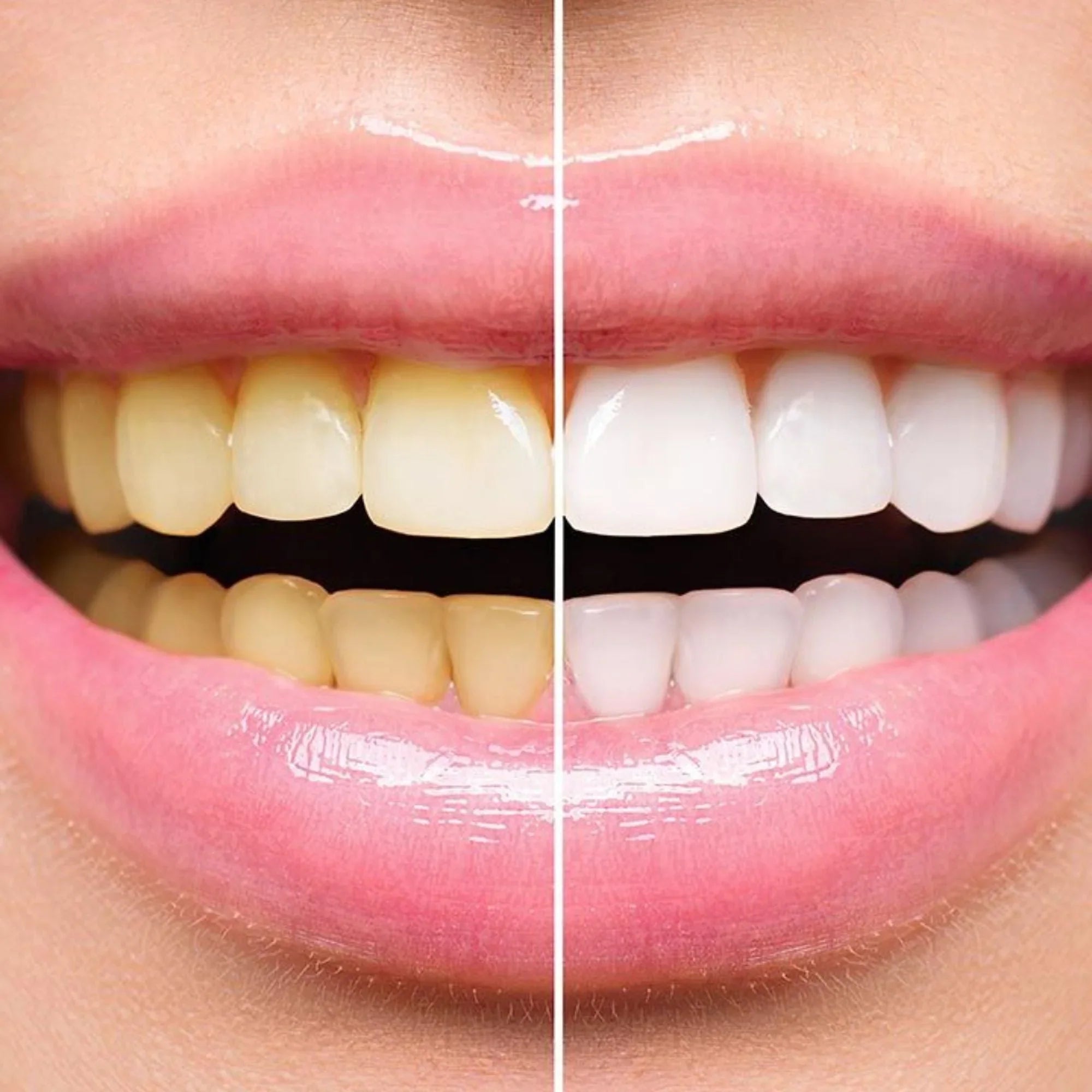Teeth Whitener