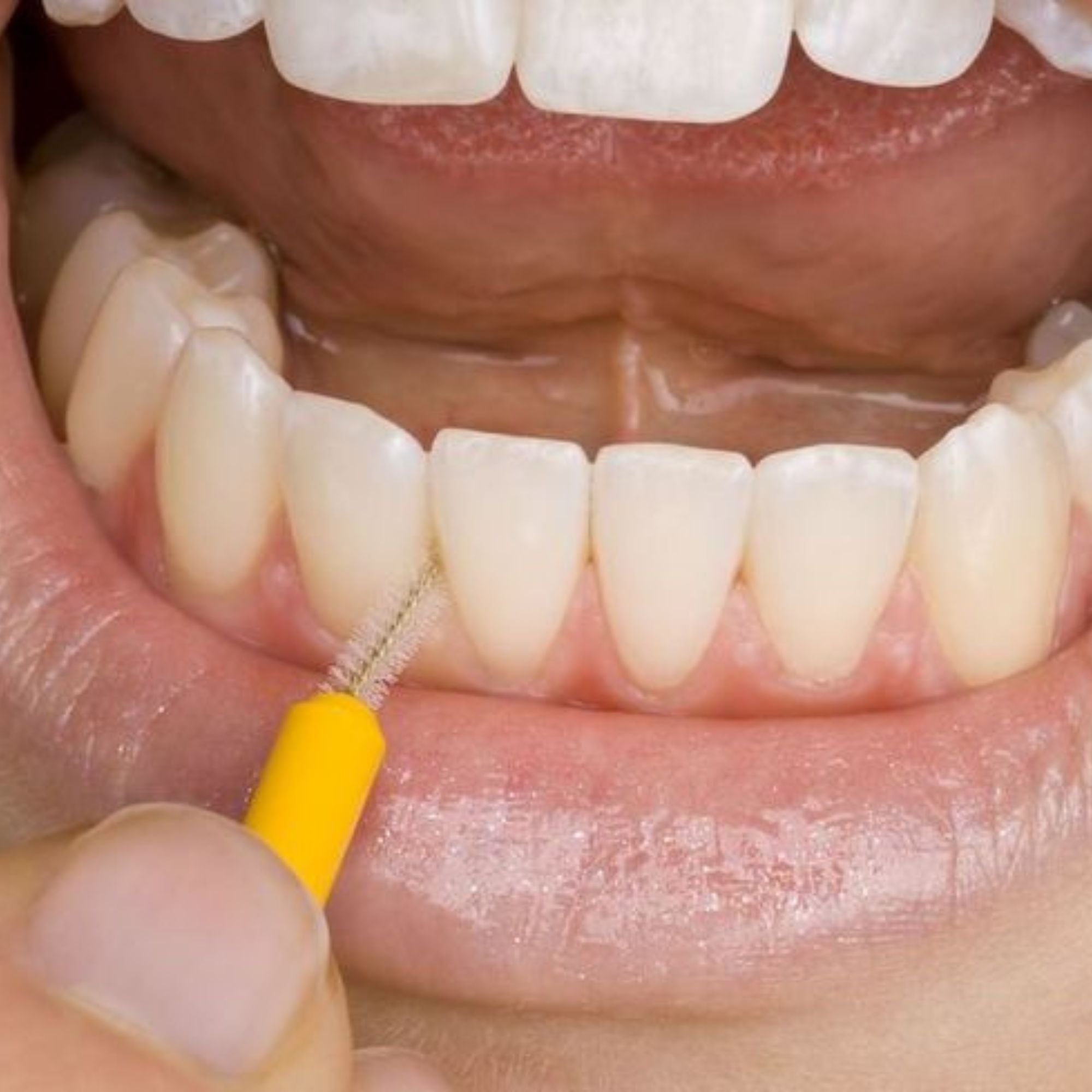 Interdental Cleaning