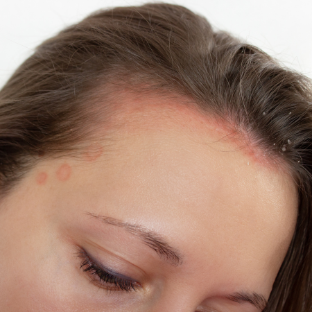 Itchy Scalp